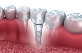 Implante dentário Implante dentário